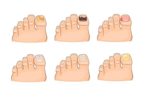 Illustration Of Nail Diseases In Neat And Modern Cartoon Style