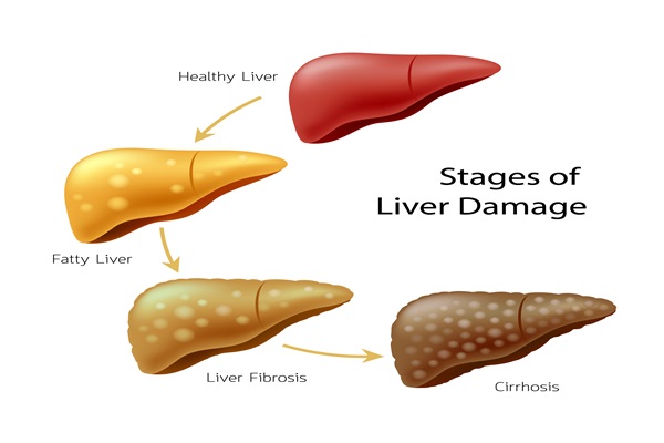 Stages Of Liver Damage. Liver Disease. Healthy, Fatty, Fibrosis